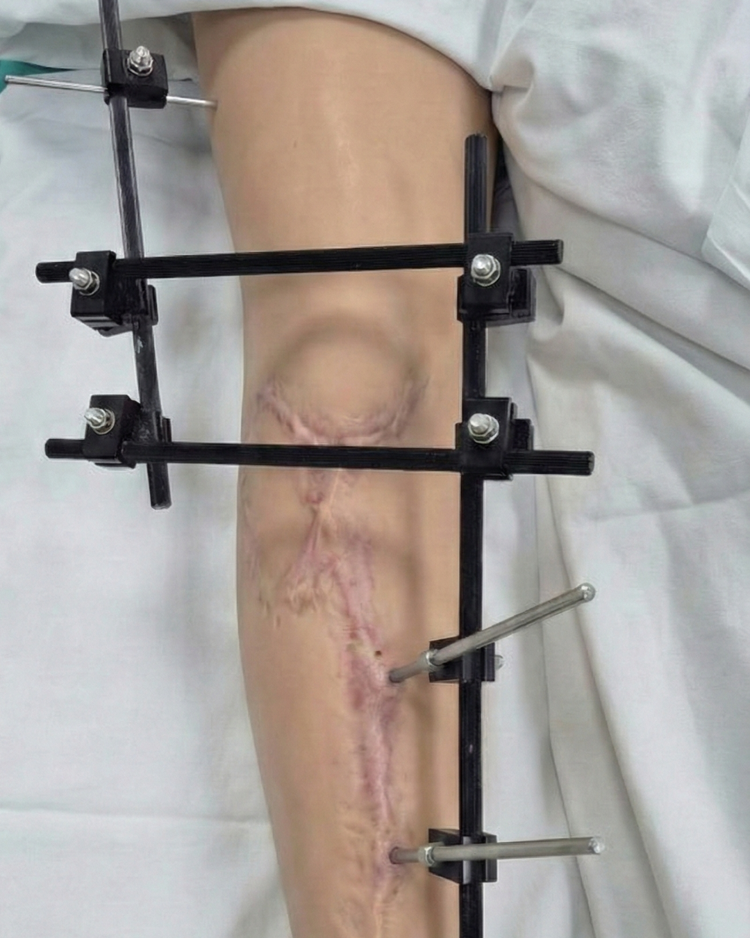 Fixador Linear aplicado em tíbia